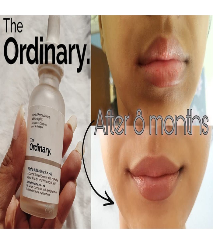 سرم آلفا آربوتین ۲% + هیالورونیک اسید اوردینری 30میلی لیتر